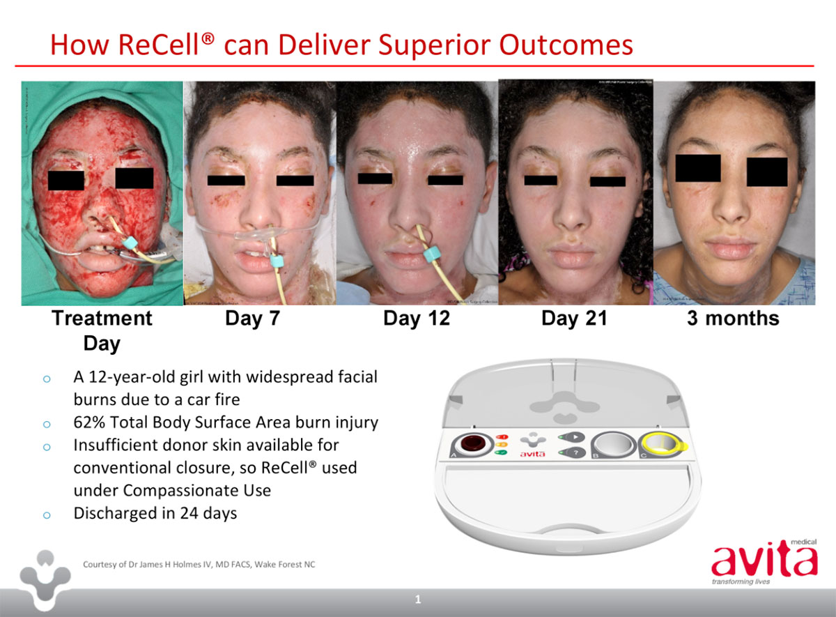 A slide showing how ReCell works from Avita's June 2017 presentation.