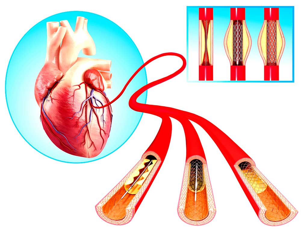 Traditional angioplasty procedures use metal stents. Graphic: Getty