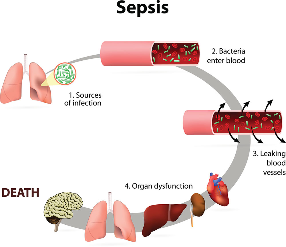 Life-threatening ... sepsis can cause organ dysfunction and death. Graphic: Getty