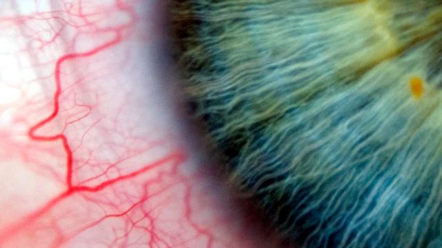 Opthea is hoping to develop new treatments for macular degeneration. Picture: Getty