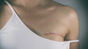 A breast prosthesis maker use Polynovo's polymer technology to make a “breast sling” and prosthesis. Pic: Getty