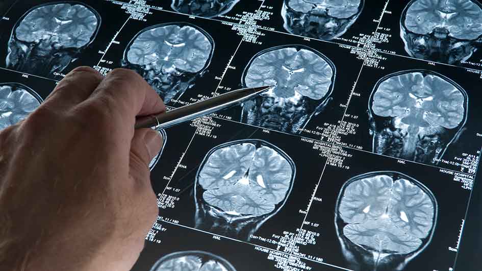 Actinogen on track with Alzheimer’s trial as research falls into line