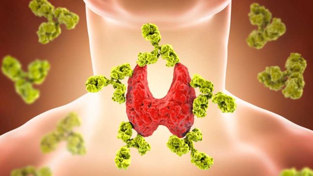 An illustration of autoimmune thyroiditis (Hashimotos disease), shows antibodies attacking the thyroid. Pic: Getty