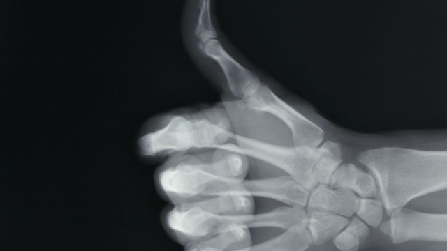 osteopore crack us bone healing market