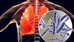 legionnaire's disease bacteria
