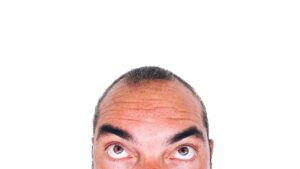 baldness